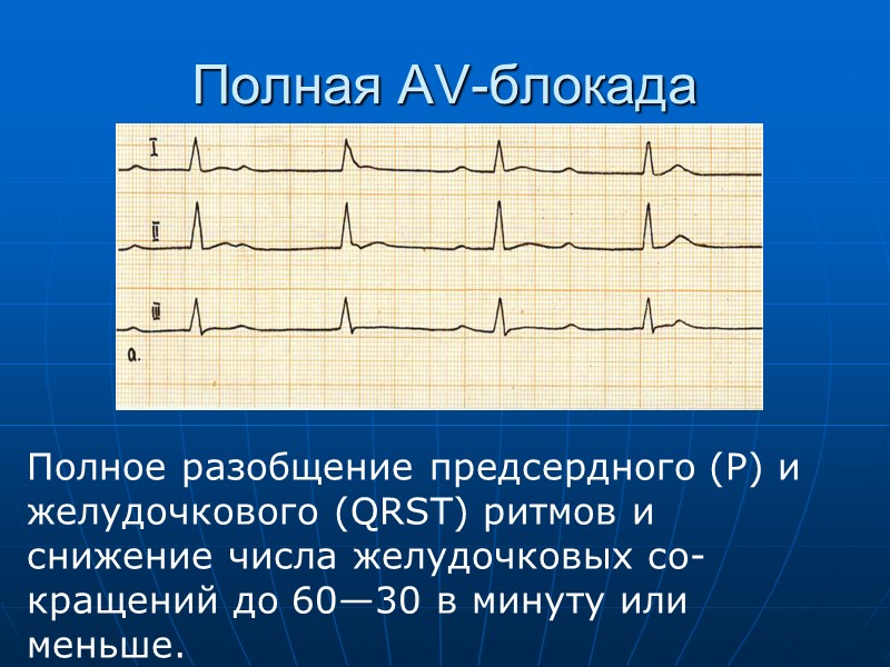 Полная AV-блокада Полное разобщение предсердного (Р) и желудочкового (QRST) ритмов и снижение числа желудочковых
